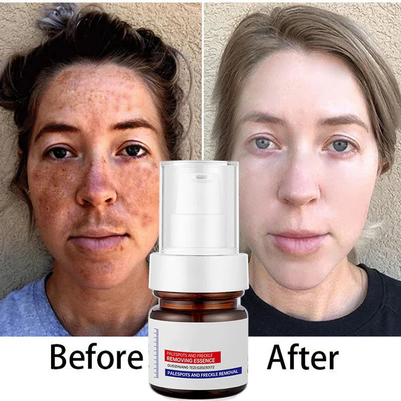 LOVILDS™ WHITENING ANDFRECKLE REMOVING ESSENCE
