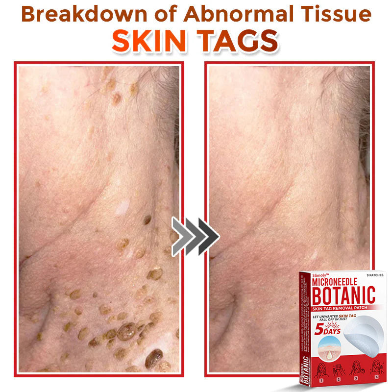 Slimoly™ MicroNeedle Botanic Skin Tag Removal Patch