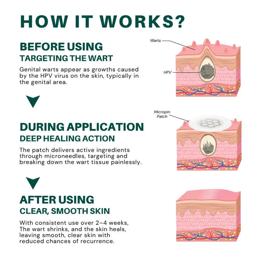 Juxek®  Wart Removal Pain-Free, Clinically Proven Solution
