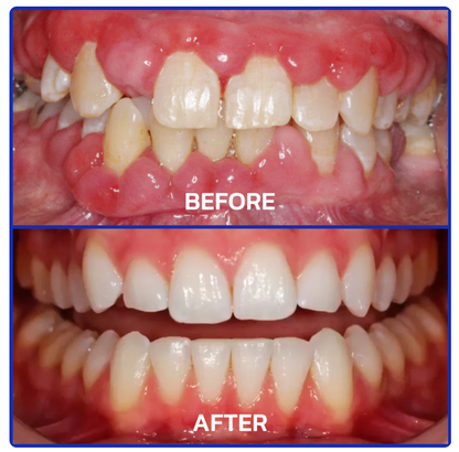 SmileFitPro™bee venom treatment powder for oral use