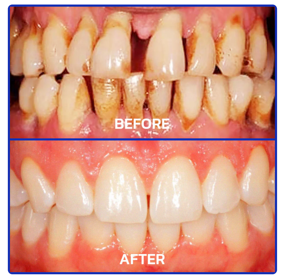SmileFitPro™bee venom treatment powder for oral use