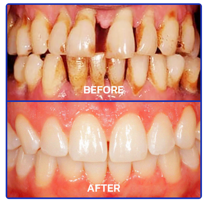 SmileFitPro™bee venom treatment powder for oral use