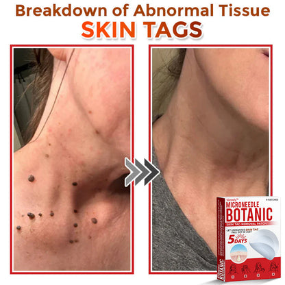 Slimoly™ MicroNeedle Botanic Skin Tag Removal Patch