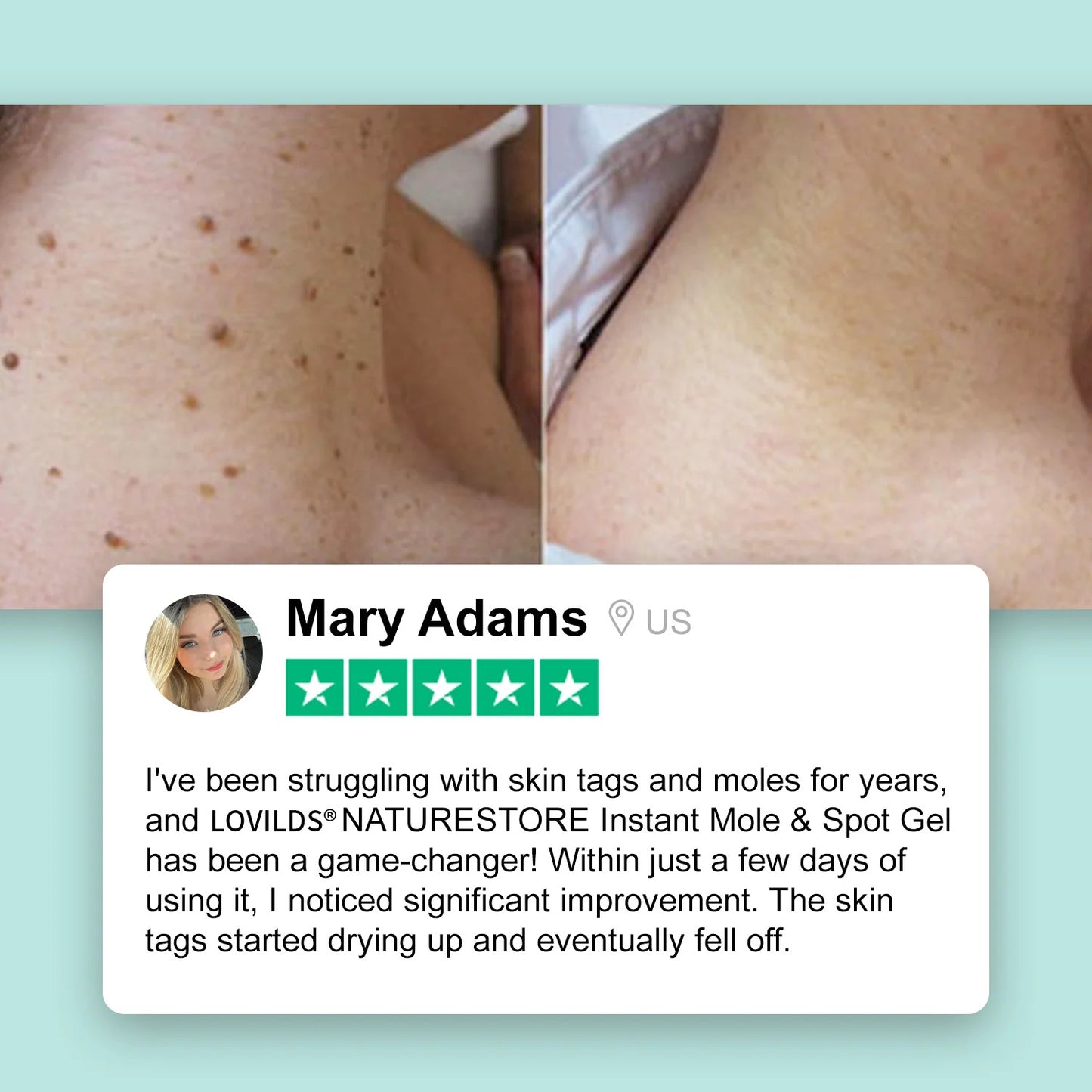 LOVILDS™NATURESTORE Instant Mole & Spot Gel