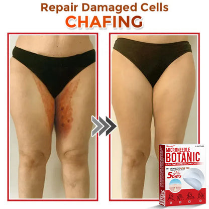 Slimoly™ MicroNeedle Botanic Skin Tag Removal Patch